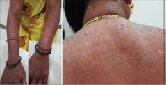 Pyrazinamide induced Photodermatitis