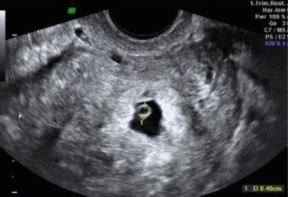 Transvaginal ultra-sonography of ectopic pregnancy