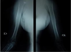 X- ray of long bone showing demineraliza-tion